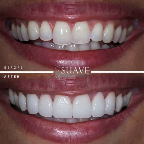 Transforming Smiles Across Borders ✨🇮🇹 Our esteemed patient from Italy chose Suave Dental Clinic in Istanbul for a stunning dental laminate veneer transformation. Discover the art of a perfect smile. Schedule your consultation today. 🌟 . . . . . #smiletransformations #dentalveneers #suavedentalclinic #istanbuldentist #elegantsmile #cosmeticdentistry #smiledesigner Dental Laminate, Perfect Teeth Smile, Perfect Teeth, Dental Veneers, Smile Teeth, Perfect Smile, Cosmetic Dentistry, Dental Clinic, Laminate