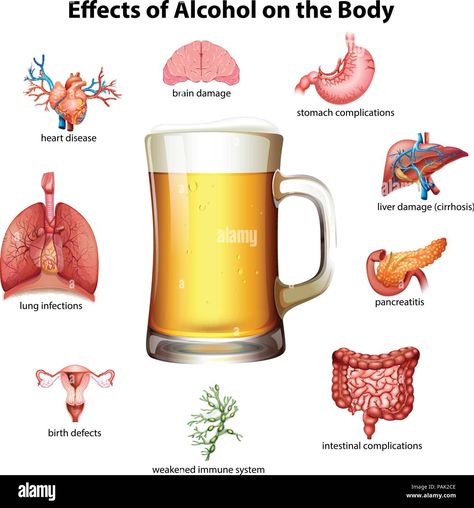 Download this stock vector: Effects of alcohol on the body illustration - PAK2CE from Alamy's library of millions of high resolution stock photos, illustrations and vectors. Alcohol Awareness, Bodybuilding Transformation, Healthy Heart Tips, Lung Infection, Effects Of Alcohol, Digestive Juice, Natural Antibiotics, Mango Recipes, Brain Damage