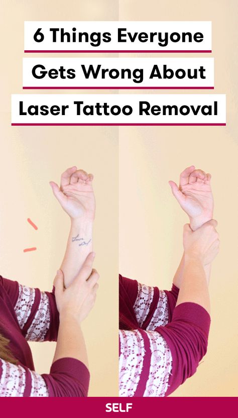 Though lasers are helpful, efficient, and effective when it comes to tattoo removal, there are a bunch of misconceptions about what they can (and can’t) do. Before you willingly get that questionable song lyric etched into your forearm—or take the plunge to have something old removed—here’s what you should know about the laser process first. Laser Tattoo Removal Process, Tattoo Removal Before And After, Tattoo Removal Laser, Remove Tattoo, Tattoo Tips, Beginner Tattoos, Omerta Tattoo, Laser Removal, Bat Tattoo