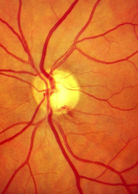 Optic nerve hemorrhage can be a sign of worsening glaucoma with loss of nerve fibers. Diagram Of The Eye, Eye Nerves, Optician Training, Optometry Education, Swollen Eyelid, Element Project, Microscopic Photography, Medical Photography, Optic Nerve