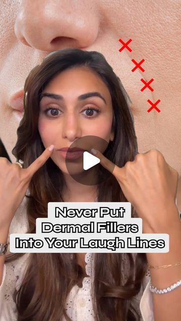 Hudson Derm & Laser Surgery on Instagram: "Instead of injecting dermal fillers directly into your laugh lines, here's what you should know...⁠
⁠
"Laugh lines are a normal anatomic structural part of the face, however, can deepen with age. To soften their appearance, we have to consider the cause of the fold. Overtime, we go through bone resorption, leading to a smaller zygomatic arch. By adding support to the midface, we provide a lifting effect to the cheek, softening the nasolabial fold.⁠
⁠
We support the nasolabial ligament by adding an injection point at the base of the nasal ala. *This is an advanced injection point and should only be performed by a skilled practitioner*⁠
⁠
Believe it or not, the lower face affects the nasolabial fold as well! By supporting the chin, we induce myomodu Fine Lines Around Mouth, Filler Nasolabial Folds, Nasolabial Folds Dermal Fillers Before And After, Lip Filler Injection Points, Nasal Labial Folds Filler, Nasal Fold Filler Before And After, Nasal Labial Folds Before And After, How To Get Rid Of Laugh Lines, Dermal Fillers Before And After