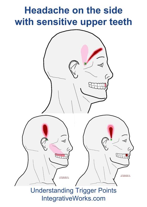 Understanding Trigger Points - Headache with sensitive upper teeth Punkty Spustowe, Natural Teeth Whitening Diy, Natural Teeth Whitening Remedies, Tooth Ache, Holistic Dentistry, Sensitive Teeth Remedy, Black Teeth, Coconut Oil For Teeth, Teeth Whitening Remedies