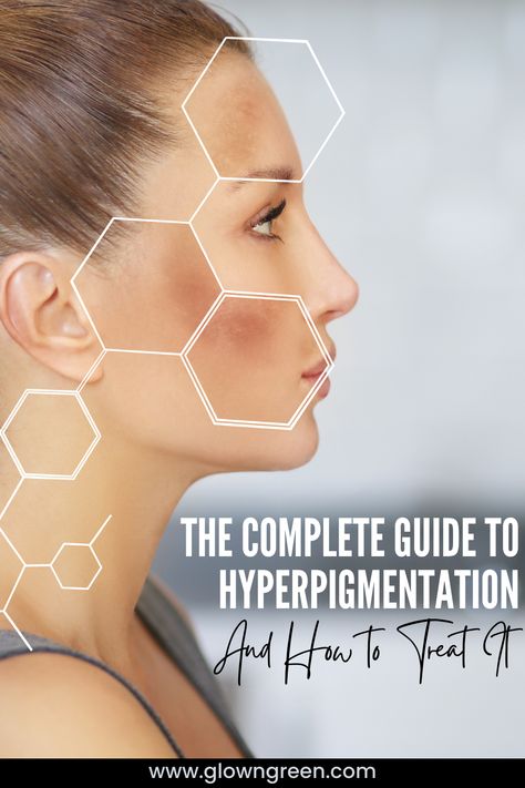 Hyperpigmentation is a discoloration of the skin that is not caused by any health condition. It can be caused by sun exposure, acne, or injury. Check out our simple guide! Face Mask For Dark Spots, Body Hyperpigmentation, Mask For Dark Spots, Face Hyperpigmentation, Powder Face Mask, Hyperpigmentation Serum, Lemon Face, Lemon On Face, Moisturizing Routine