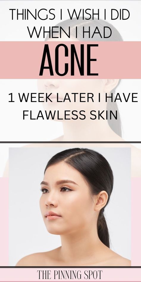 How to clear acne almost overnight and have beautiful skin (I wish I had done this when I had acne) Acne Scab, Face Acne Treatment, Acne Scaring, Acne Overnight, Bad Acne, Pimple Scars, Post Acne Marks, Oily Skin Acne, Beauty Makeover