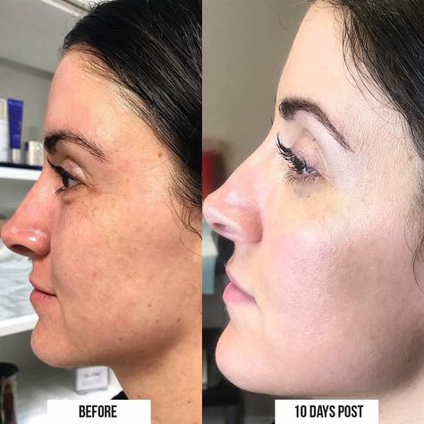 Charleston Medical Spa on Instagram: “Mascara only in both photos. Now that is a Halo Glow. 🦄 Last chance to cash in on May’s Special, $300 Off the Halo Hybrid Fractional Laser…” Halo Laser, Halo Glow, Fractional Laser, Medical Spa, Last Chance, Charleston, Halo, Spa, Medical