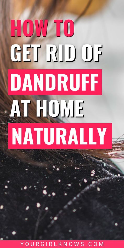 How to get rid of dandruff naturally at home : Looking for quick ways to get rid of dandruff and get a clear scalp at home? These natural remedies for dandruff are tried and tested for the problem. How To Get Rid Of Dandruff Overnight, Get Rid Of Dandruff Permanently, Natural Remedies For Dandruff, Get Rid Of Dandruff Fast, How To Remove Dandruff, Natural Dandruff Remedy, Hair Mask For Dandruff, Clear Scalp, Dandruff Solutions