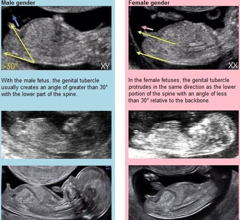 nubtheory | Flickr - Photo Sharing! Baby Gender Ultrasound, Ultrasound Gender Prediction, Ultrasound Student, Ultrasound Gender, Baby Gender Predictor, Nub Theory, Obstetric Ultrasound, Gender Predictor, Baby Gender Prediction