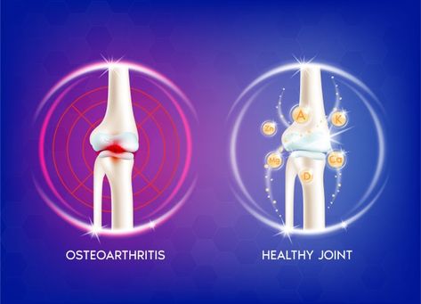 Human Bone Anatomy, Human Joints, Bone Anatomy, Anatomy Skeleton, Human Knee, Knee Health, Vitamin Therapy, Health Ads, Medical Packaging