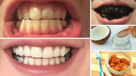 Home Remedies for Teeth Whitening Teeth Whitening Professional, Teeth Tips, Coconut Oil Teeth Whitening, Natural Teeth Whitening Remedies, Sensitive Teeth Remedy, Teeth Whitening Homemade, Teeth Whitening Remedies, Whitening Teeth, Teeth Whitening Diy