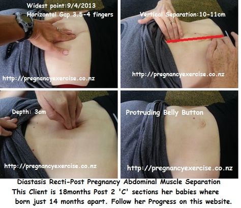 What is diastasis post pregnancy? Have a look at mum of 2 Erins separation- Diastasis Recti Post Pregnancy Muscle Separation - pregnancyexercise.co.nz Diastasis Recti Surgery, What Is Diastasis Recti, Tummy Exercises, Muscle Separation, Finger Spaces, Pregnancy Exercise, Diastasis Recti Exercises, Body After Baby, Post Pregnancy Workout