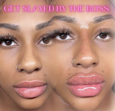 Bratz Lip Fillers, Lip Blushing Black Women, Filler Black Women, Lip Filler Black Women, Filler Inspiration, Bestie Photoshoot, Under Eye Fillers, Botox Lips, Lip Blush