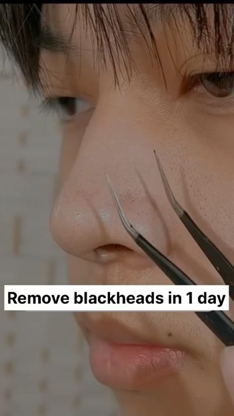 Blackheads Removal , Clogged Pores & Open Pores Tightening Home Remedies Blackheads Removal, Open Pores, Clogged Pores, Blackhead Remover, Blackheads, Home Remedies, Friends Family, With Friends, The World