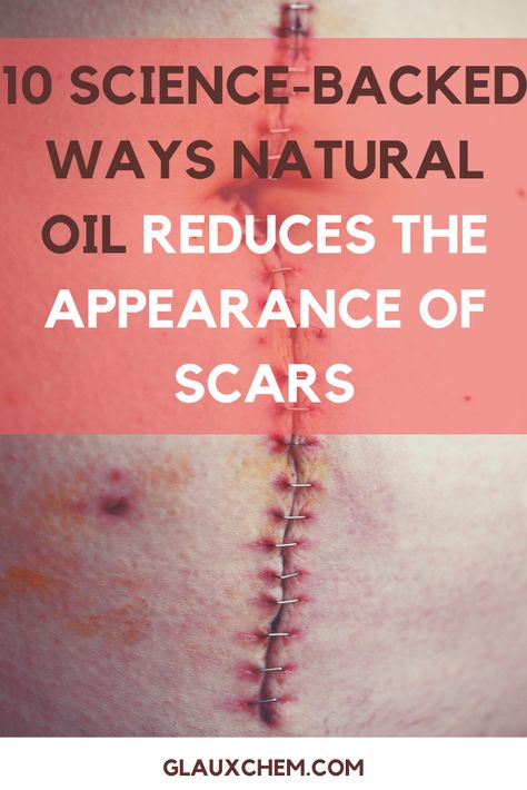 Scar Healing Remedies, Getting Rid Of Scars, Scar Remedies, Oils For Scars, Facial Scars, How To Fade, Lighten Scars, Rid Of Blackheads, Get Rid Of Blackheads