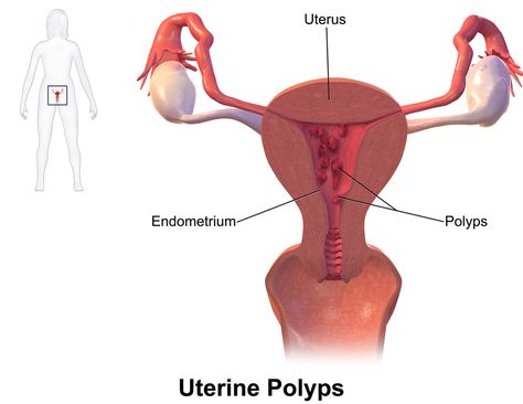 Polyps Uterus, Endometrial Polyps, Uterine Polyps, Oxalate Diet, Fibroid Uterus, Low Oxalate, دورة شهرية, I Know Nothing, Polycystic Ovaries