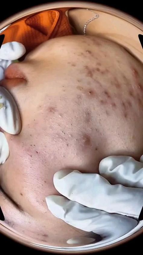 what Is this??#acne #pimple #blackhead #pimplepop #pop #satisfying #viral Pimple Poppìng, Closed Comedones, Skin Blackheads, Blackhead Scrub, Zit Popping Videos, Zits Popping, Types Of Acne, Clear Complexion, Best Moisturizer