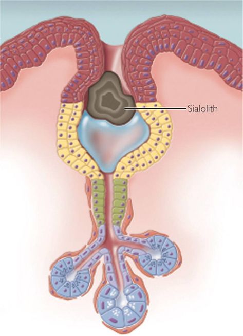 Sialolithiasis - About Salivary Gland Stones - ENT Clinic Sydney Salivary Gland Stone, Ent Clinic, Ear Nose Throat, Parotid Gland, Dry Eye Symptoms, Calcium Deposits, Salivary Gland, Facial Nerve, Biology Notes