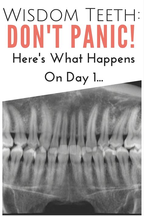 Wisdom Teeth: Don't Panic! Here's What Happens On Day 1 | www.thegingermarieblog.com Getting Wisdom Teeth Out, Wisdom Teeth Removal Food, Wisdom Teeth Removal Recovery, Wisdom Teeth Video, Wisdom Teeth Food, Wisdom Teeth Pain Relief, Wisdom Teeth Recovery, Wisdom Teeth Pain, After Wisdom Teeth Removal