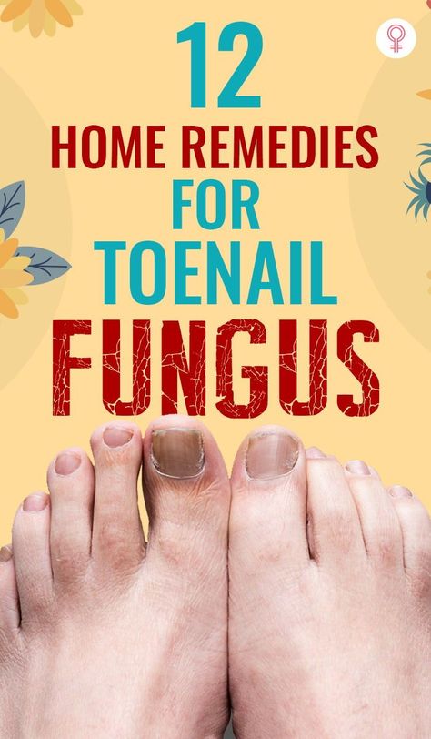 12 Home Remedies For Toenail Fungus: While over-the-counter prescription medications are the best way to treat toenail fungus, due to the strong side effects of these medications people experience, they are opting for natural alternatives #remedies #homeremedies #nailfungus Nail Remedies, Toenail Fungus Remedies, Nail Fungus Remedy, Natural Alternatives, Fungal Nail, Ingrown Toe Nail, Healthy Liver, Toenail Fungus, Nail Fungus