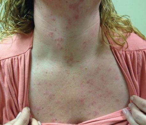 A 37-year-old woman had presented at the end of the summer with a pruritic rash, which had originally started on her neck then slowly progressed to the face, chest, shoulders, and arms. Groin Rash, Viral Rash, Home Remedies For Rashes, Fungal Rash, Body Rash, Rash On Face, Rash On Neck, Rashes Remedies, Home Remedies For Allergies