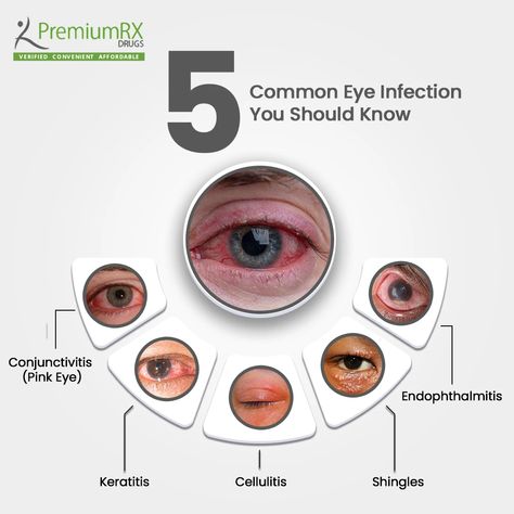 Did you know about these 5 Common Eye Infections? 👀 Stay informed and keep those eyes healthy! 1️⃣ Conjunctivitis (pink eye) 2️⃣ Keratitis 3️⃣ Cellulitis 4️⃣ Shingles 5️⃣ Endophthalmitis Knowledge is the best defense. Share to spread awareness! 👁️💡 #premiumrxdrugs #EyeHealth #StayInformed #EyeInfections #ProtectYourEyes Pink Eye Infection, Optometry Humor, Eye Medicine, Pinkeye Remedies, Eye Facts, Tech Week, Eye Infections, Eye Logo, Nursing School Studying