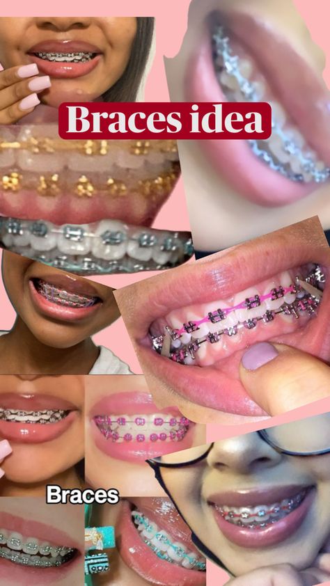 Dental Braces Colors, Pink Braces, Cute Braces Colors, Pretty Teeth, Braces Tips, Getting Braces, Dental Aesthetics, Braces Girls, Cute Braces