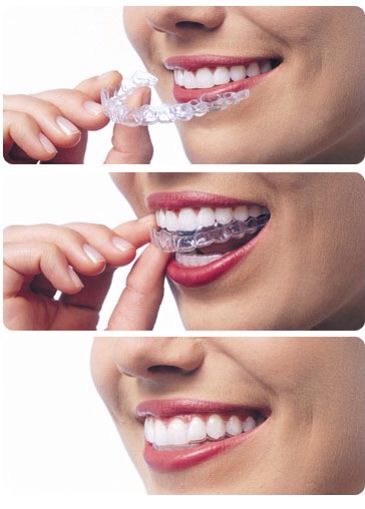 Invisalign  Aligners Invisalign Aligners, Dental Social Media, Dental Images, Teeth Alignment, Dental Posts, Dental Posters, Invisible Braces, Kesehatan Gigi, Dental Braces