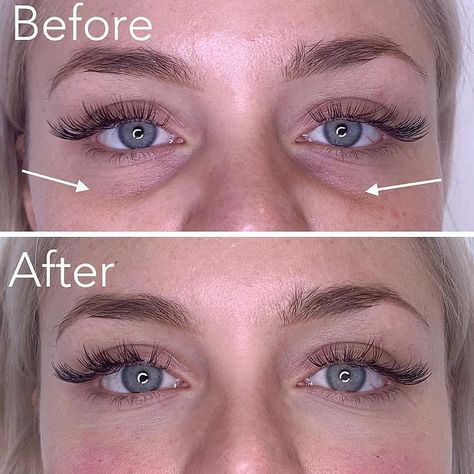 The BEST in Cosmetics on Instagram: “Before/after tear trough filler for dark under eye circles. Thoughts? Comment ⬇️ . . This work was done by @dr.rebecka.gardell . . . . . .…” Tear Trough Filler, Eye Lift Surgery, Dark Under Eye Circles, Bags Under Eyes, Under Eye Fillers, Face Fillers, Sunken Eyes, Under Eye Circles, Under Eye Makeup