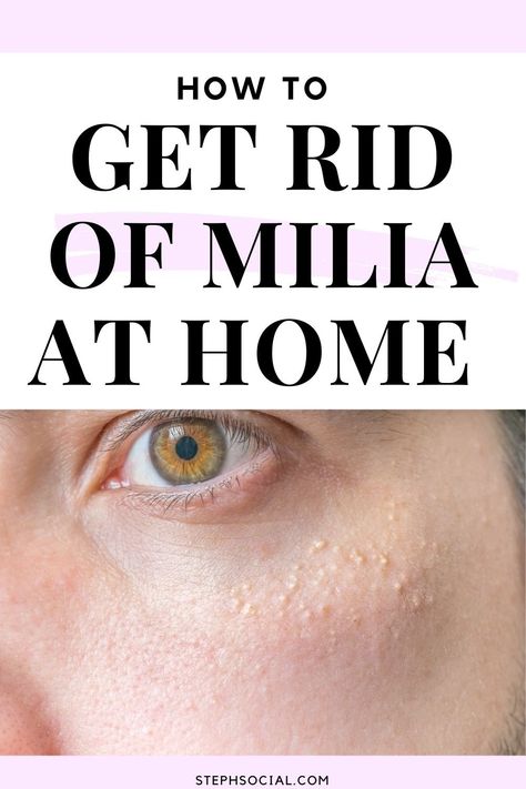 How To Get Rid Of Whiteheads On Face, Skin Care Routine For Milia, Remove Milia On Face, How To Get Ride Of White Heads On Face, How To Get Rid Of Sebum On Face, Small White Bumps On Face, How To Remove Milia Under Eyes, Getting Rid Of Whiteheads On Face, Millia Removal How To Get Rid