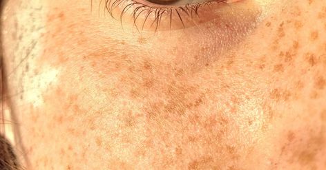 How To Get Rid Of Sun Damage On Face, Reverse Sun Damage On Face, Sun Damage On Face, Mole People, Rash On Face, Is It Too Late, Skin Moles, Dna Repair, Uneven Skin Texture