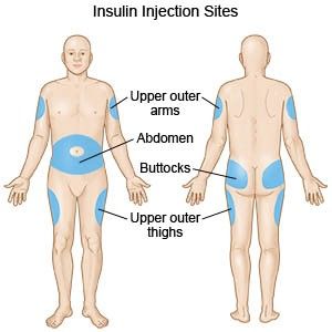 Insulin Injection Sites, Insulin Injection, Injection Sites, Psychiatric Nursing, Nursing School Survival, Fundamentals Of Nursing, Nursing School Studying, Nursing School Tips, Nursing Tips