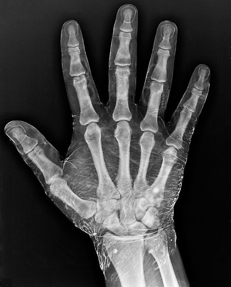 A radiograph of a hand dipped in iodine. The density of the fluid on the surface allows the visibility of soft structures that a radiograph would not normally show in detail. X Ray Hand, Xray Humor, Hand Anatomy, Radiology Technologist, Anatomy For Artists, Hand Reference, Anatomy Drawing, Mini Lessons, Ex Machina