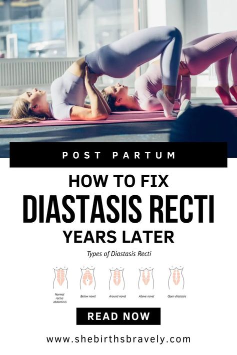 Diastasis Recti is a condition where the right and left sides of the rectus abdominis muscles separate. This separation occurs along the linea alba, which is the connective tissue that runs down the middle of the abdominal wall. The condition is commonly associated with pregnancy, as the growing uterus places pressure on the abdominal muscles, causing them to stretch and separate. However, Diastasis Recti can also occur in men and women who have not been pregnant. Diastis Recti Exercises, Fix Diastasis Recti, Heal Diastasis Recti, Diastasis Recti Repair, Diástase Abdominal, Healing Diastasis Recti, Post Baby Workout, Diastasis Recti Exercises, 12 Minute Workout