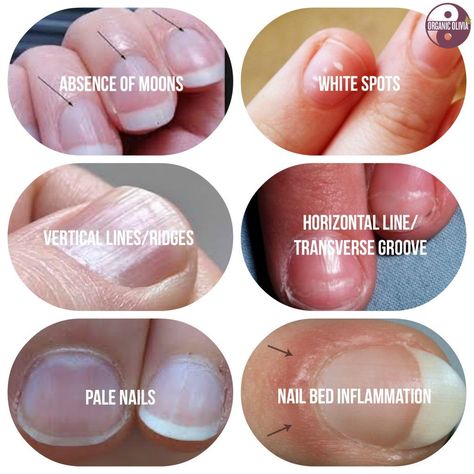 Fingernail Health, Nail Health, Health Info, Natural Medicine, Health Remedies, Body Health, Natural Healing, Herbal Remedies, Holistic Health