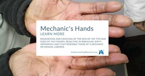 Mechanic's Hands and Myositis Mechanics Hands, Autoimmune Disease, Disease, Cards Against Humanity, Repair