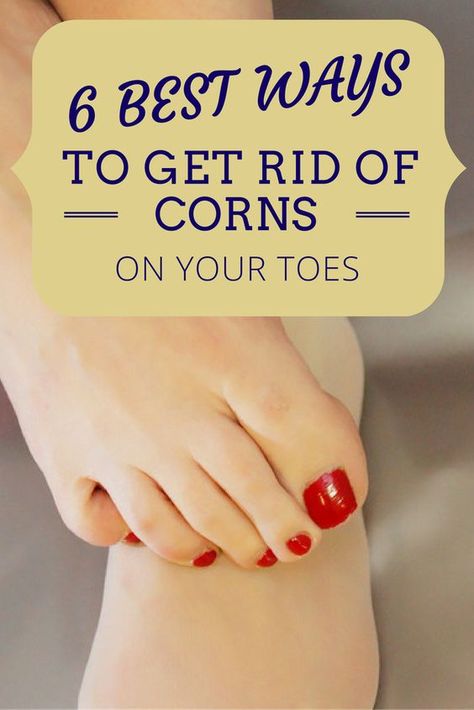 Get Rid Of Corns On Feet Fast, Foot Corn Removal Remedies, How To Get Rid Of Corns On Toes, Corn Removal On Toes, Get Rid Of Corns, Corn Removal, Foot Soaks, Diy Pedicure, Fungal Nail