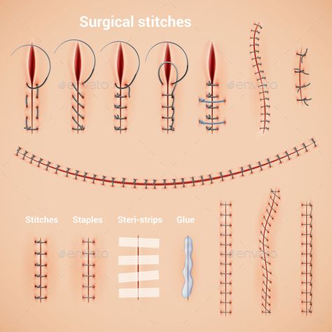 Surgical Stitches Infographic Set #Stitches, #Surgical, #Set, #Infographic Weird Medical Facts, Surgical Stitches, Arm Lift Surgery, Studera Motivation, Surgical Suture, Vet Medicine, Medicine Studies, Surgical Nursing, Medical Student Study