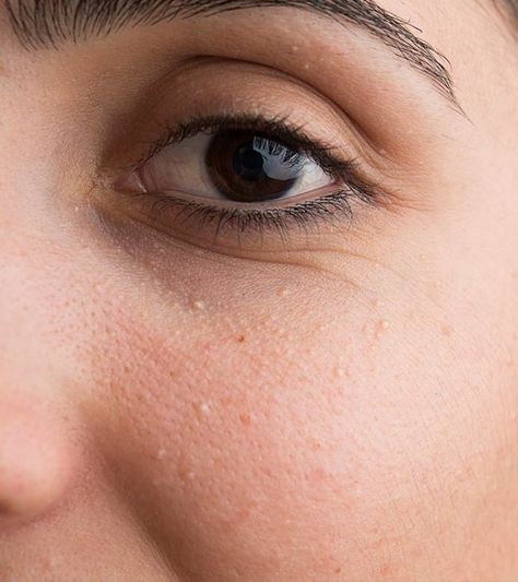 How To Get Rid Of Milia White Pimples On Face, White Bumps On Face, Eminence Organic Skin Care, Pimples On Face, Spots On Face, Dermatology, Skin Tightening, Skin Conditions, Eye Care