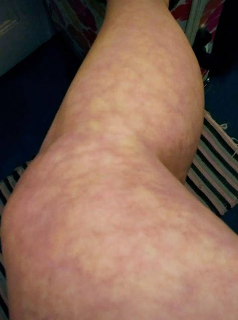 Livedo Reticularis, Low Thyroid Remedies, Autoimmune Disease Symptoms, Thyroid Remedies, Low Thyroid, Sjogrens Syndrome, Disease Symptoms, Autoimmune Disorder, Adrenal Fatigue