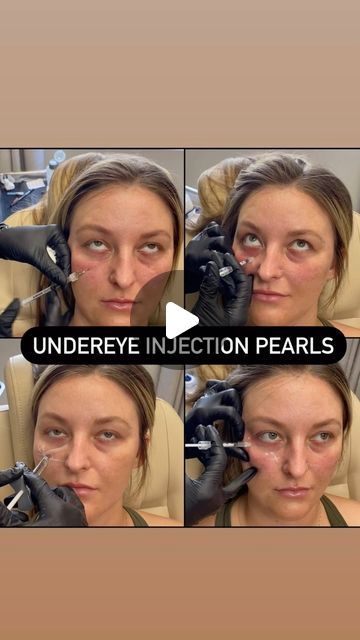 Nicola Lowrey PA-C on Instagram: "Undereye Injection Pearls

▪️Midface support is critical.
Never approach the under eyes in isolation.
The tear trough deformity is a symptom.  The true etiology comes from the boney changes in the orbit and the maxilla.  As well as the deep fat pad loss and descent of the Soof, exposing the orbital rim.
The “money shot” is the deep medial cheek fat pad.
This will support the ligamentous strain visualized as the Nasojugal groove and the tear trough.

▪️Supraperiosteal bolus injections under the ORL.
The product will be in the SOOF, which has a 97% surface volume coefficient.  The “bang for your buck” here is very high.

▪️I don’t typically inject directly into the true tear trough!
Medial injections are placed superficially, with a diluted product.
A skin g Botox Under Eyes, Face Injections, Cheek Fat, Under Eye Fillers, Aesthetic Dermatology, Tear Trough, Cheek Fillers, Injectables Fillers, Money Shot