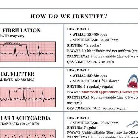 shanu.ECG on Instagram: "EKG Rhythms Cheat Sheet!!🫀Learn to identify and treat these rhythms. This is PACKED with info…I tried to make it as simple as I can for y’all 🥰 Save and share with a friend!! . Follow us for more information 👇 @knowledge.of.ecg . . Thanks for this post @stephaneebeggs . . #ecg #ekg #cardiology #ecginterpretation #electrocardiograma #electrocardiogram #nursing #cardiologista #healthy #interpretation #heart #nurse #knowledgeofecg #hearts #heartbeat #ccu #cardio #cardiov Ekg Interpretation Cheat Sheet, Ecg Rhythms Cheat Sheets, Ekg Rhythms, Ekg Interpretation, Ecg Interpretation, Pr Interval, P Wave, Respiratory Therapy, Cardiology