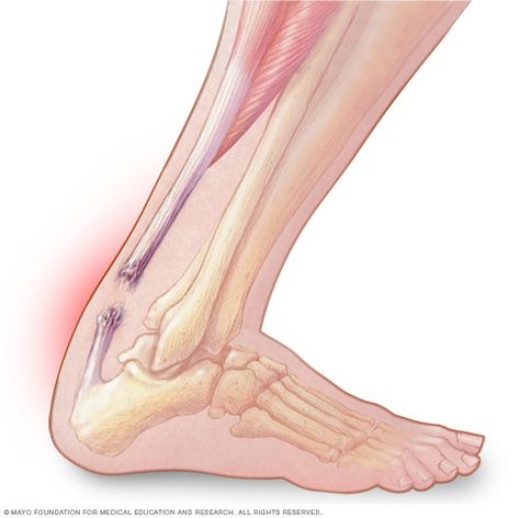 Achilles tendon rupture: Is surgery necessary? Achilles Tendon Ruptures, Football Injury, Ankle Fracture, Ankle Surgery, Achilles Tendon, Lower Limb, Sciatic Nerve Pain, Sprained Ankle, Sciatic Nerve