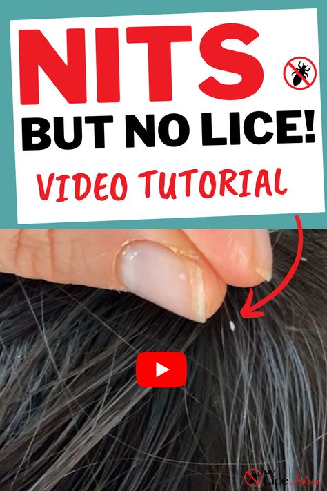 How To Remove Lice From Head, Lice And Nits Remedies, How To Remove Nits From Hair, Best Way To Get Rid Of Lice And Nits, How To Get Rid Of Lice Eggs, Getting Rid Of Lice Fast, Home Remedy For Lice And Nits, Natural Remedies For Lice, How To Remove Lice Eggs From Hair