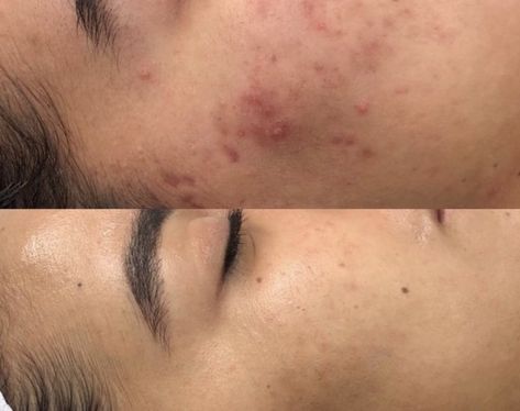 Microneedle Before And After, Esthetician Before And After, Before And After Facial Pictures, Before And After Microneedling, Skin Before After, Facials Before And After, Skin Before And After, Dermapen Before And After, Micronidelling Face