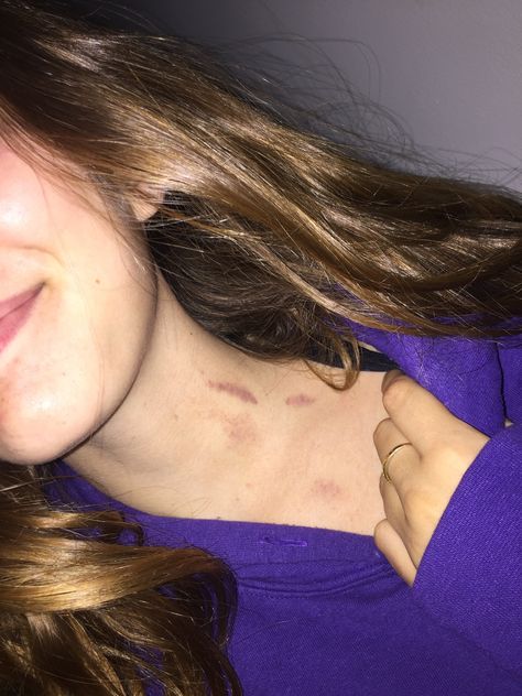 Chest Love Bites Hickey, Hickey Girls, Love Bites Aesthetic, Hickies Neck Aesthetic Girl, Hickies Neck Boys And Girl, Love Bites Hickey, Neck Full Of Hickeys, Love Bite Photos, Hickies Neck Aesthetic