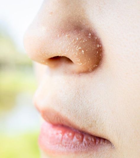 10 Remedies To Heal Dry Skin Around The Nose Dry Nose Skin, Dry Nose Remedy, Nose Peeling, Dry Skin Home Remedies, Dry Peeling Skin, Chin Exercises, Baking Soda Benefits, Dry Nose, Healing Dry Skin