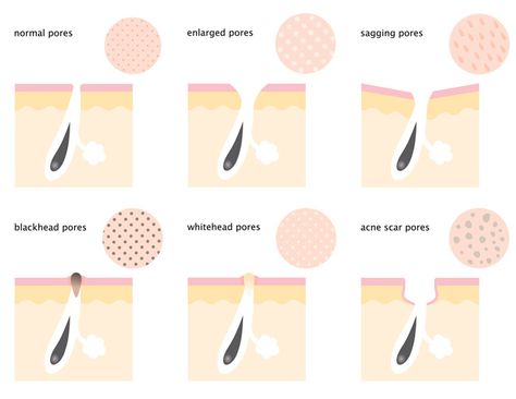 Although there is nothing you can do to actually decrease pore size, you can minimize their appearance. Here is how to minimize pores on your face for good. Skin Care Routine For Teens, Dusky Skin, Laser Skin Resurfacing, Nose Pores, Face Pores, Skin Care Routine For 20s, Laser Skin, Large Pores, Skin Pores