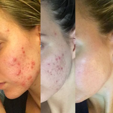 Before And After Acne, Redness Pimple, Clear Skin Fast, Skin Care Pictures, Acne Hyperpigmentation, Forehead Acne, Natural Acne Remedies, Cystic Acne, Acne Remedies