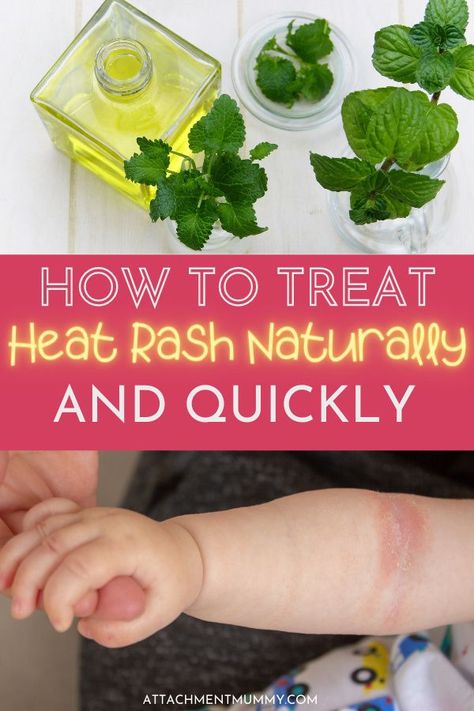 Whether you're planning a Summer holiday with kids, or simply preparing for the sunshine this natural heat rash remedy is an essential for any mom. Forget heat rash remedies loaded with toxins and chemicals, this heat rash remedy is natural and suitable for all ages. #naturalremedies #heatrashremedy #headrashremedyforkids Natural Remedies For Rashes, Prickly Heat Rash Remedies, Heat Rash Remedy For Babies, Heat Rash Remedy For Adults, Remedies For Heat Rash, Natural Rash Remedies, Treating Heat Rash, Skin Rash Remedies, Heat Rash Remedy