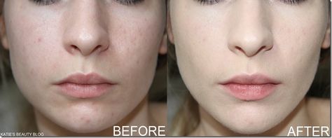 NARS SHEER GLOW BRFORE AND AFTER siberia Fair Skin Home Remedies, Skin Home Remedies, Get Fair Skin, Nars Sheer Glow Foundation, Nars Sheer Glow, Glow Foundation, Fair Skin, 2 Ingredients, Beauty Blog