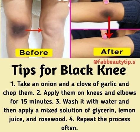 How To Lighten Underarms, Lighten Underarms, Knee Health, Skin Face Mask, Clear Healthy Skin, Natural Skin Care Remedies, Dark Underarms, Good Skin Tips, Skin Care Face Mask